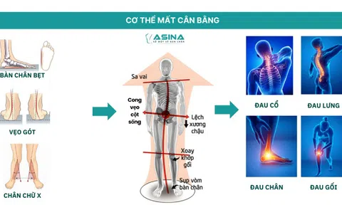 Lót giày chỉnh hình 3D ASINA, “ bước đột phá” trong điều trị bàn chân bẹt và cân bằng cấu trúc cơ thể