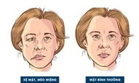Nhiễm lạnh, trúng gió: Nguy cơ dẫn đến liệt dây thần kinh số 7 ngoại biên