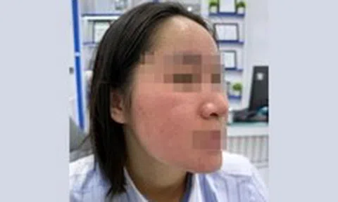 Hết trị bách bệnh, lại rước họa vì dùng nước cốt chanh trị mụn