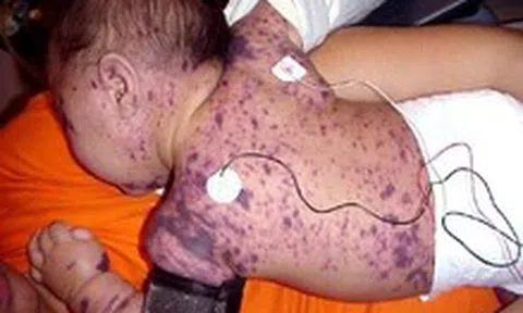 Bệnh não mô cầu dễ lây lan, nguy cơ xuất hiện thêm ca cộng đồng, phòng bệnh thế nào?