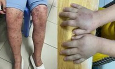 Cảnh báo bệnh ban xuất huyết Schonlein - Henoch gây biến chứng thận nguy hiểm ở trẻ em