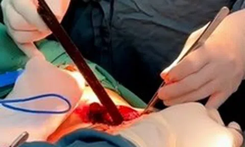 Thanh gỗ đâm xuyên ngực gần 1 gang tay, nam thanh niên thoát chết kỳ diệu