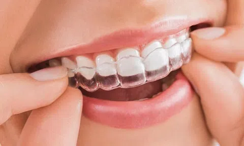 Những lưu ý đặc biệt khi niềng răng để khỏi 'tiền mất tật mang'