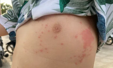 Nhiều người bị sứa lửa 'tấn công' khi tắm biển Nha Trang