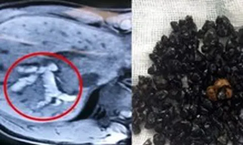 Ký sinh trùng chui lên đường mật nguy hiểm ra sao?