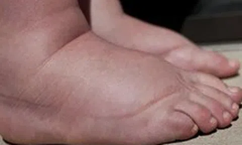 Trẻ đột nhiên bị phù, coi chừng mắc bệnh lý thận nguy hiểm