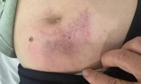 Xác minh vụ cô giáo lớp lá đánh hiệu phó trường mầm non đến nằm viện
