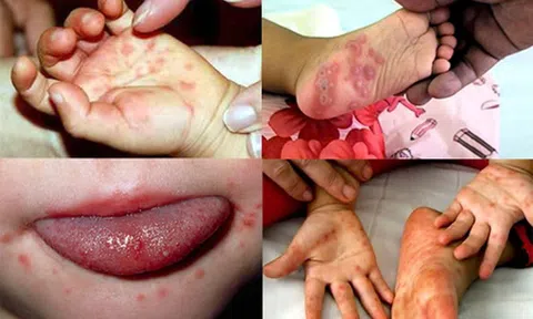 Bệnh tay chân miệng ở trẻ và cách chăm sóc an toàn từ Nước lá bàng Lão Nhà Quê