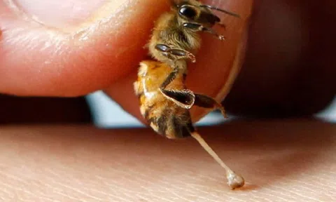 Dùng ong đốt để điều trị ung thư, người phụ nữ phải cắt bỏ cả hai bên ngực
