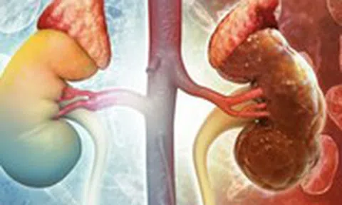 18 tuổi đã bị hỏng thận vì thói quen ăn uống