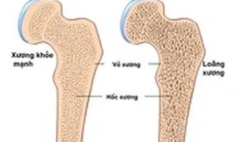 Làm gì để phòng ngừa bệnh loãng xương?