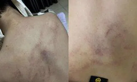 Gia đình tố cô giáo mầm non đánh, kéo lê, ném bé gái 4 tuổi vào tường