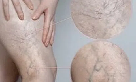 Chân đau nhức, mạch máu lộ rõ cảnh báo bệnh lý đang đe dọa 1/3 người trưởng thành