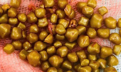 Mổ cấp cứu nữ bệnh nhân có hơn 100 viên sỏi chứa đầy trong túi mật
