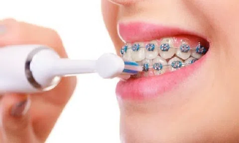Hai lợi ích ít được biết đến của việc niềng răng