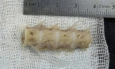Hóc đoạn xương sống cá 4cm trong cổ, cụ ông 99 tuổi nguy kịch