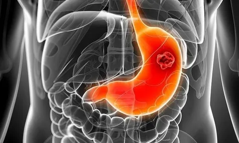 Bác sĩ chỉ cách ăn uống ngừa ung thư dạ dày