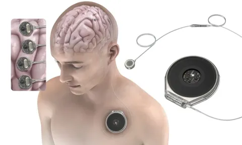 Đối thủ của Neuralink được thử nghiệm cấy chip vào não người