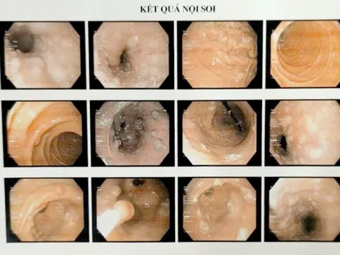 Hy hữu ca bệnh có u chi chít trong dạ dày và mọc khắp cơ thể