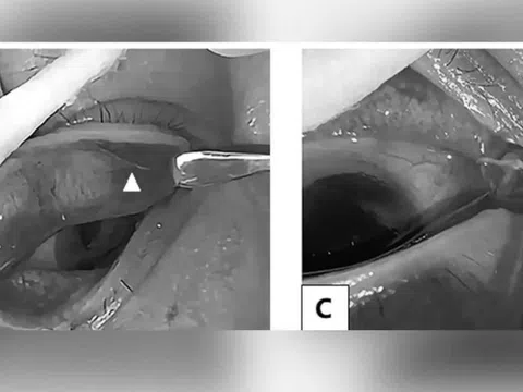 Bác sĩ phát hiện giun sống dưới mí mắt của một phụ nữ