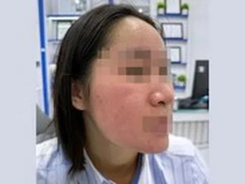 Hết trị bách bệnh, lại rước họa vì dùng nước cốt chanh trị mụn