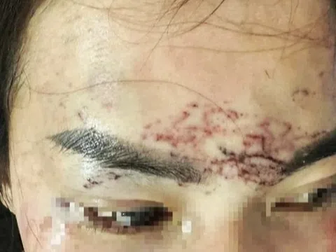 Khởi tố vụ án người phụ nữ 'tố' bị bắt giữ, đánh đập, xăm mặt vì ghen