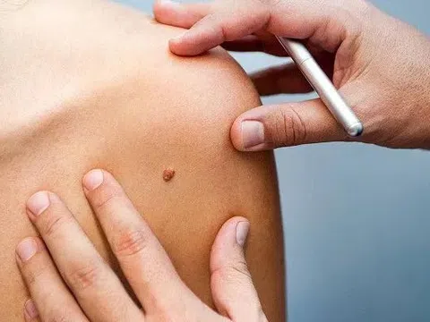 Căn bệnh ung thư có nguyên nhân từ môi trường và lối sống hằng ngày, dấu hiệu chỉ là một chấm 'bé như đầu tăm'