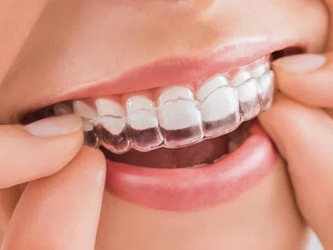 Những lưu ý đặc biệt khi niềng răng để khỏi 'tiền mất tật mang'