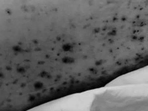 Thanh niên 30 tuổi nguy kịch vì thủy đậu, bệnh tưởng chừng hay gặp ở trẻ em