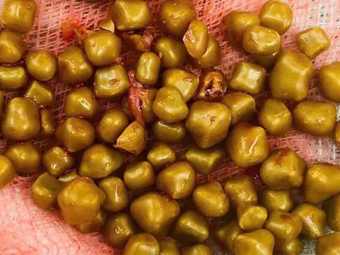 Mổ cấp cứu nữ bệnh nhân có hơn 100 viên sỏi chứa đầy trong túi mật