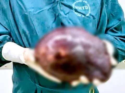 Cắt khối u gan khổng lồ nặng 2,5kg